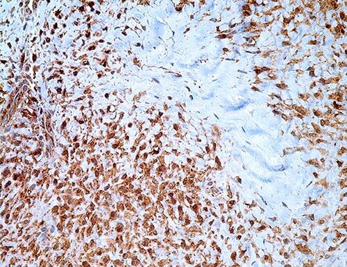 IHC of Beta-Catenin on an FFPE Breast Fibromatosis Tissue